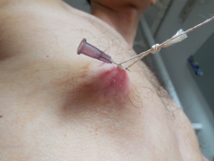 My tits in pain (nipples removed) - N